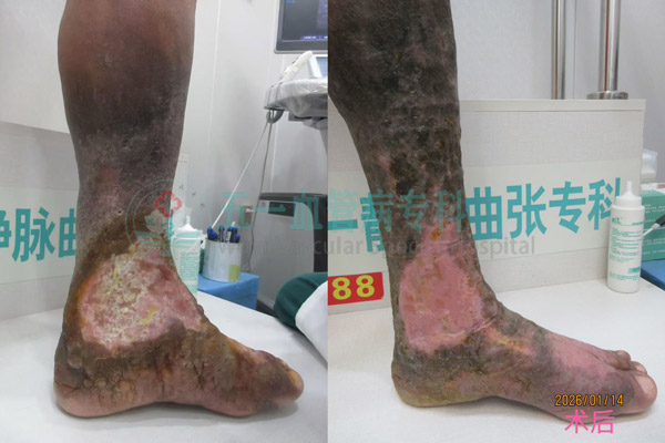 沈阳重度静脉曲张病例！沈阳静脉曲张专科医院帮您分析与综合治疗方法探讨！
