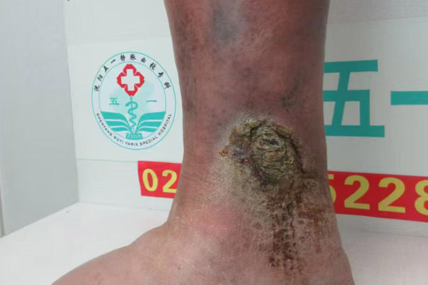 沈阳静脉曲张医院