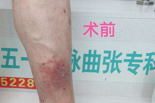 大连静脉曲张专科医院