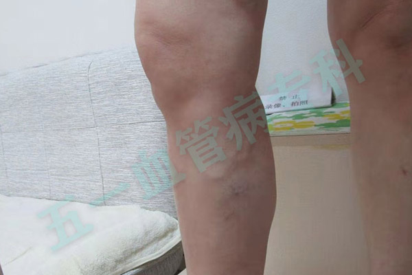 沈阳治静脉曲张的专科医院：以国际标准重塑血管健康